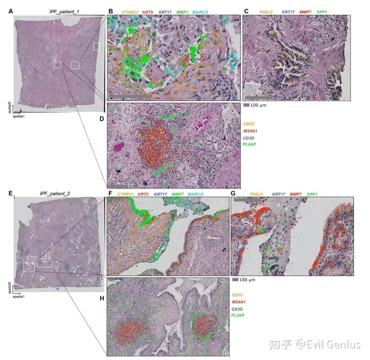 课后补充---特发性纤维化病理生态位的空间转录组学特征