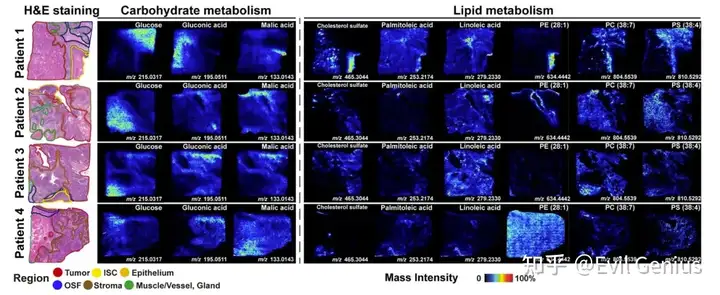 Abundance and Distribution of Metabolites Associated with Carbohydrate and Lipid  Metabolism in OSF-derived OSCC