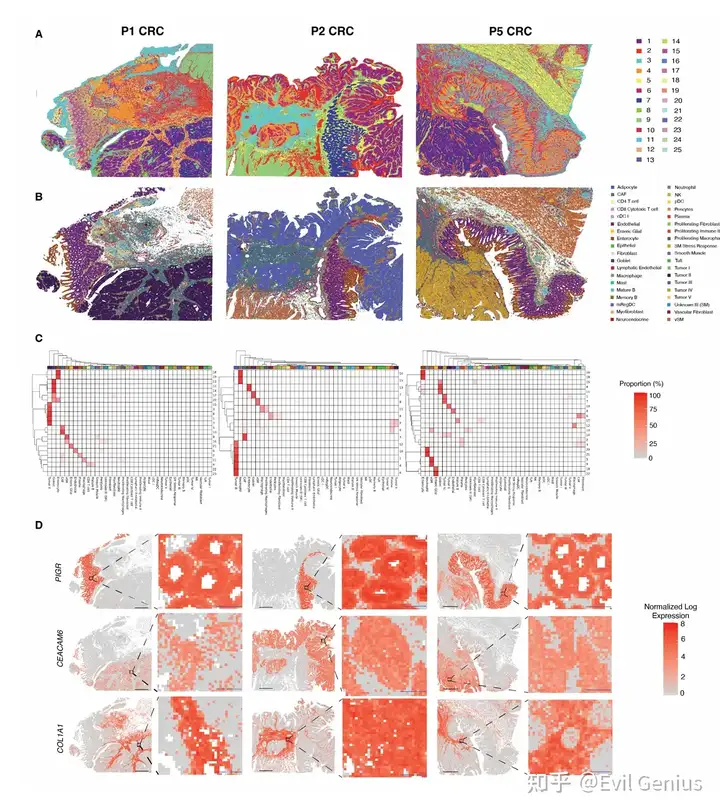 Spatial mapping of CRC samples using Visium HD reveals high resolution, accurate transcript mapping