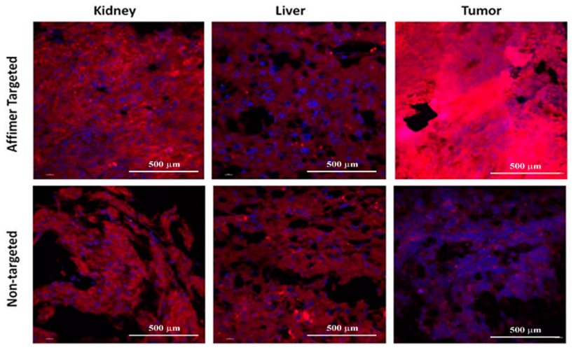 图 2. 共聚焦显微镜观察患者肾、肝和肿瘤的组织切片中 Cy5 的摄取情况[3]