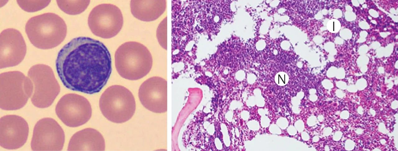 图 1. 来源于慢性淋巴细胞白血病患者的赖特-吉姆萨染色血涂片和骨髓活检标本的组织切片[1]