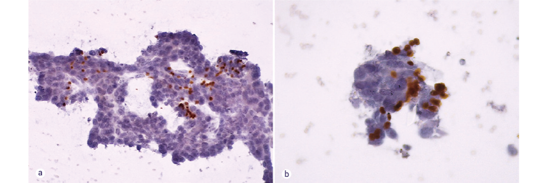 图 6. 肿瘤标志物 P63 的 ICC 检测。