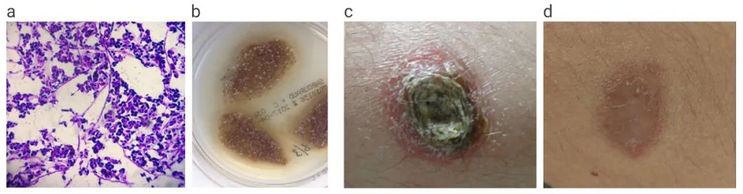 图 2. a：革兰氏染色：“雪茄体”；b：萨博罗琼脂：“盐和胡椒”菌落； c：右臂皮肤孢子丝菌病结节；d：在六次 MB-PDT 治疗后的结果[4]。