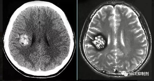 图1. 脑内海绵状血管瘤影像