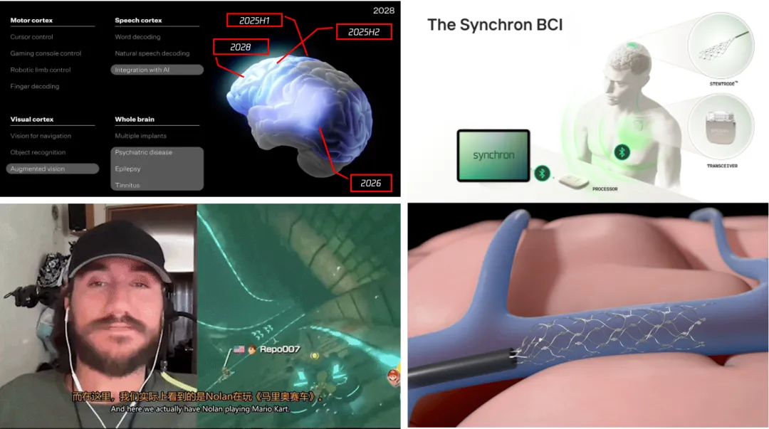 图:Neuralink 脑机接口规划和临床测试(左)、Synchron Stentrode血管介入脑机接口(右)(来源:互联网)
