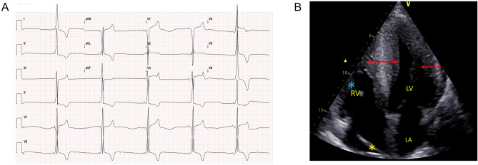 图4   PRKAG2 心肌病患者的典型心电图和超声心动图