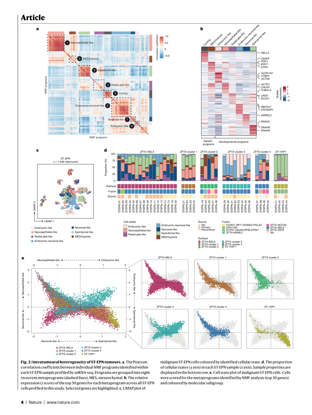 Figure 2: ST-EPN肿瘤的瘤内异质性