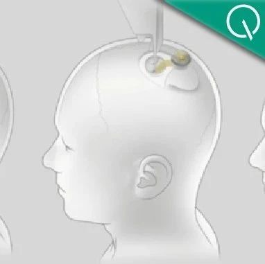 马斯克最新芯片：脑机专用，让失明人群“看见”