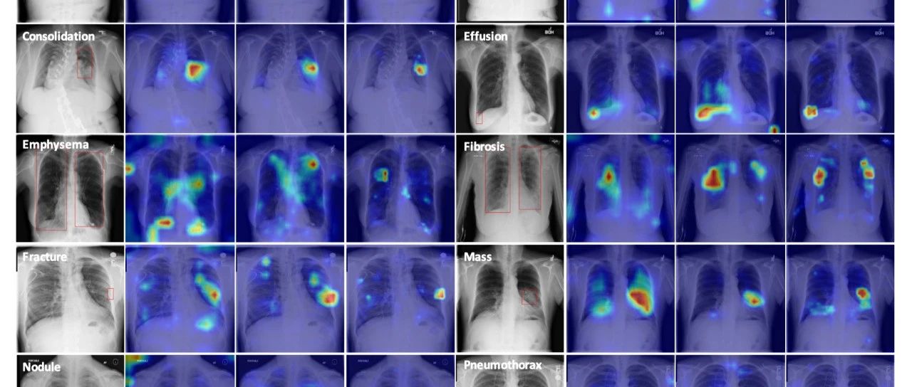 上交大&上海AI lab研发胸部X-ray疾病诊断基础模型，成果入选Nature子刊