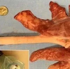 仅不到35元！中美研发全球首个用于内镜下球囊扩张术的软体机器人登《Soft Robotics》