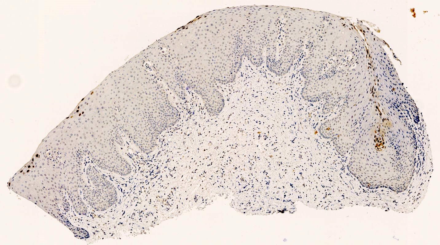 抗人乳头瘤病毒（HPV）L1 衣壳蛋白的抗体能够对上皮上三分之一处发生挖空样改变的细胞进行染色。