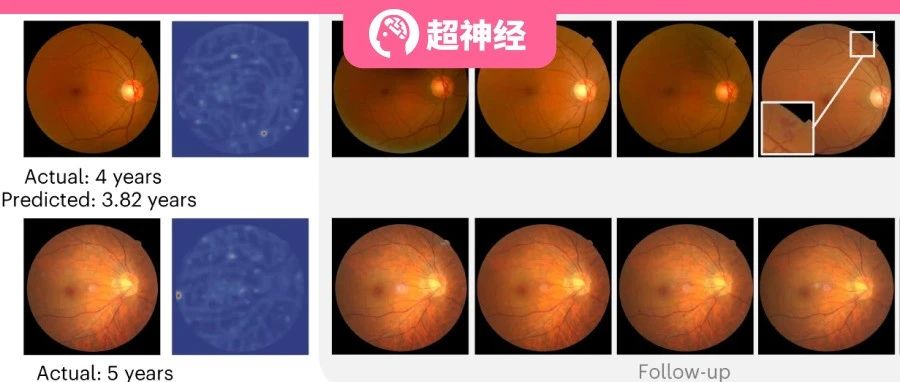 上海交大与清华联手发布 DeepDR Plus，仅用眼底图像可预测 5 年内糖尿病视网膜病变进展
