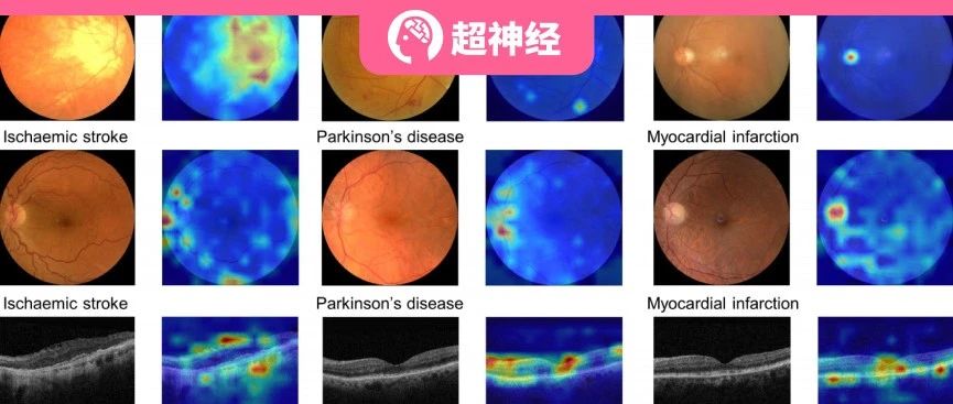 160w+ 未标注图像、3 个维度全方位评估，周玉坤等人开发 RETFound 模型，用视网膜图像预测多种系统性疾病