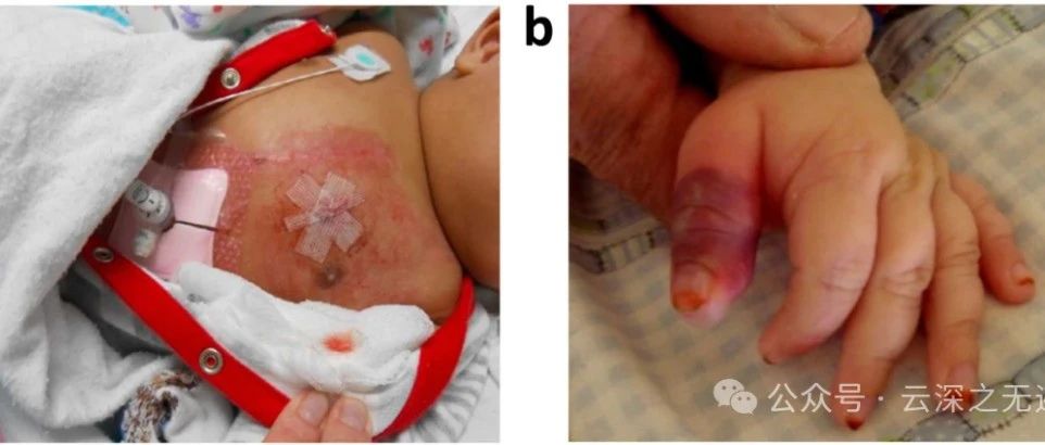 用于婴幼儿智能健康监测的皮肤接口可穿戴生物传感器