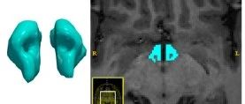 Hypothalamus Segmentation Challenge2022 ——下丘脑，海马体及子区域分割