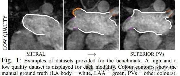 Left Atrial Segmentation Challenge 2013——MRI图像中的左心房分割