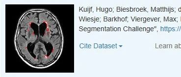WMHSegmentation2017——MRI白质高信号强度分割挑战赛