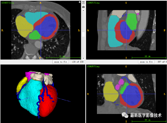ASOCA2020——CTA全心脏结构分割-腾讯云开发者社区-腾讯云