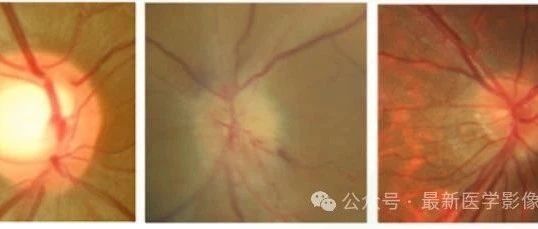 Papilledema2018——眼底图像视神经乳头水肿分类
