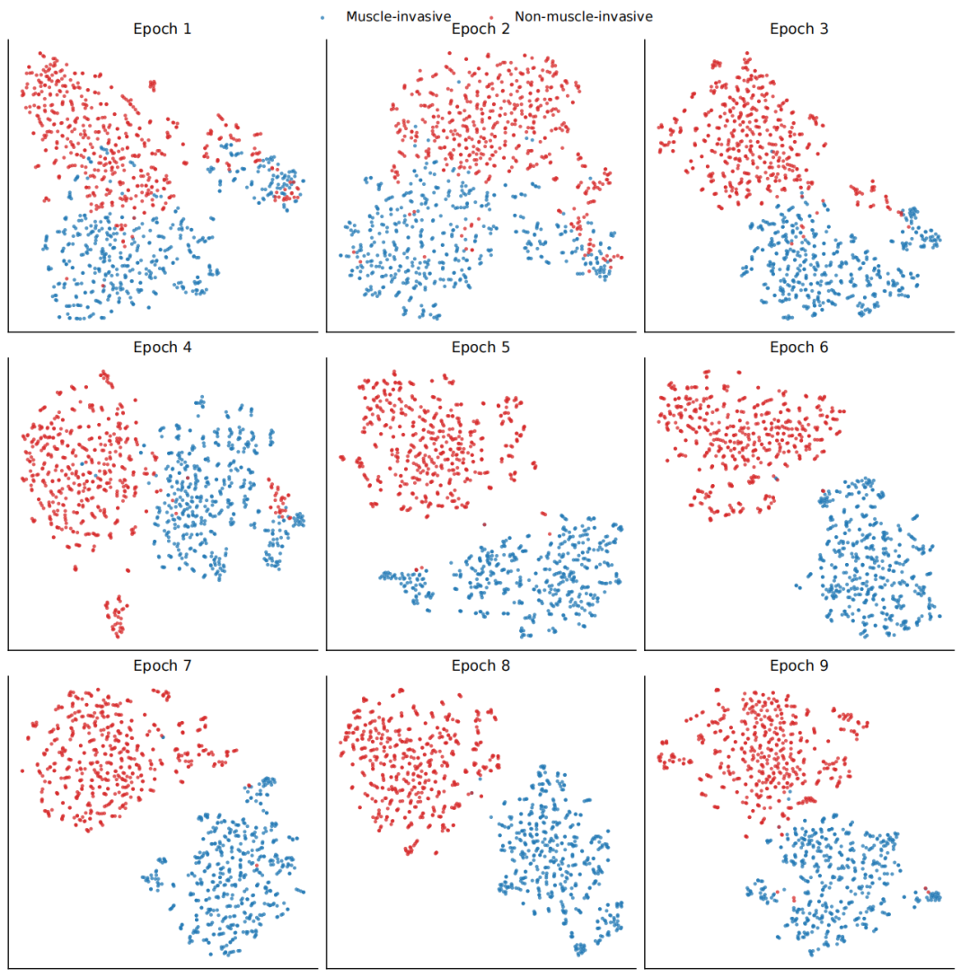 图6学习特征表示的t-SNE可视化。NMIBC和MIBC特征在不同训练阶段的t-SNE图，说明随着DADCNet学习更多的判别和域不变表示，类的逐步分离。