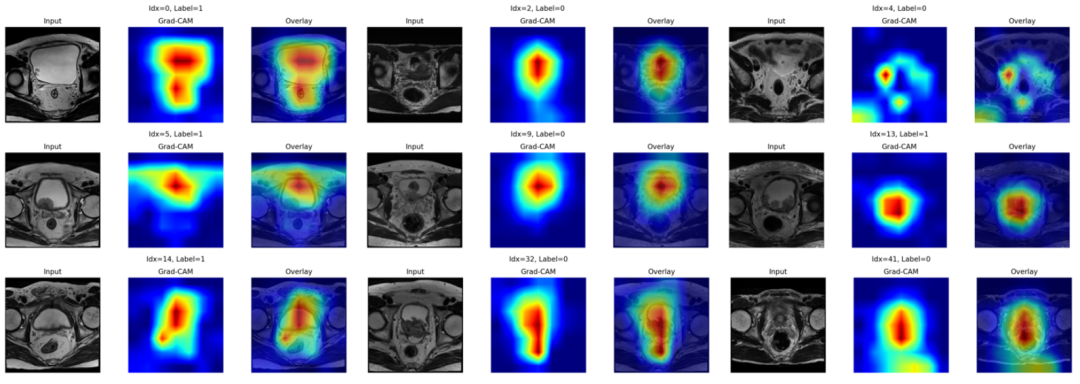图5 Grad-CAM可视化DADCNet模型。具有Grad-CAM激活图和叠加可视化的代表性MRI样本。