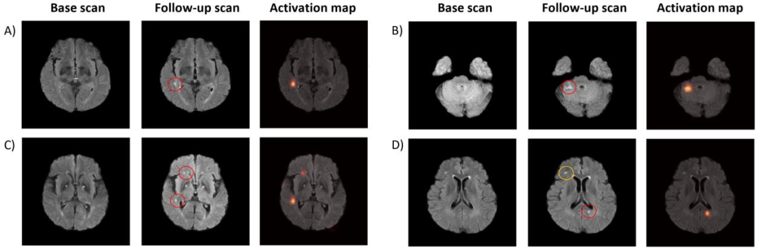 图2.模型面板A-D确定的新发展梗死的代表性案例显示了新发展梗死（后续FLAIR扫描上的红色圆圈）通过Grad-CAM激活图正确定位的示例，突出显示的区域对应于真实的病变部位。面板D显示了一个真正的新梗死（红色圆圈）和预先存在的信号变化（黄色圆圈）的案例。该模型选择性地激活了新病变，同时适当忽略了预先存在的区域，表明病变检测具有稳健的特异性。